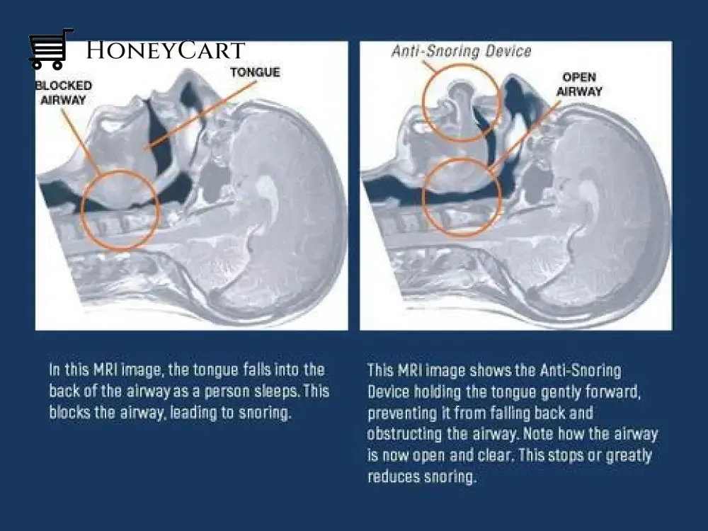 Apnea Tongue Stabilizing Device