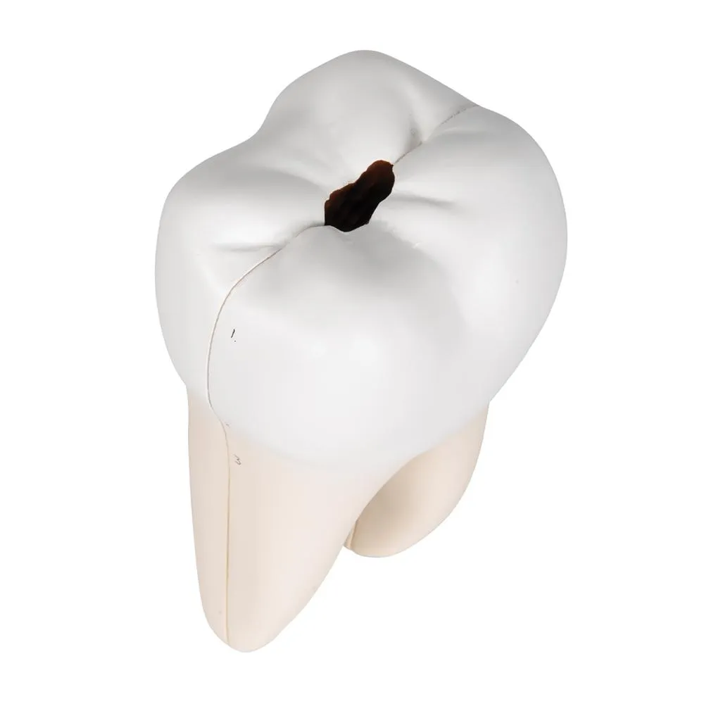 Lower Twin-Root Molar Showing Cavities, 2 part