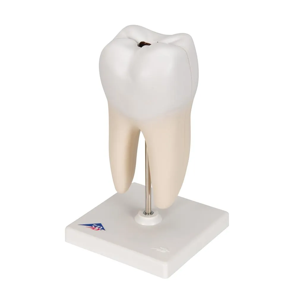 Lower Twin-Root Molar Showing Cavities, 2 part