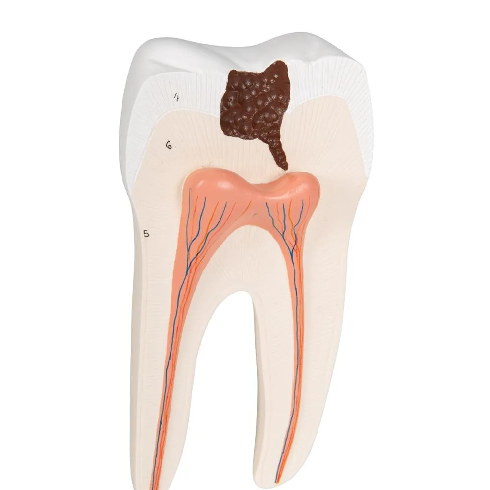 Lower Twin-Root Molar Showing Cavities, 2 part