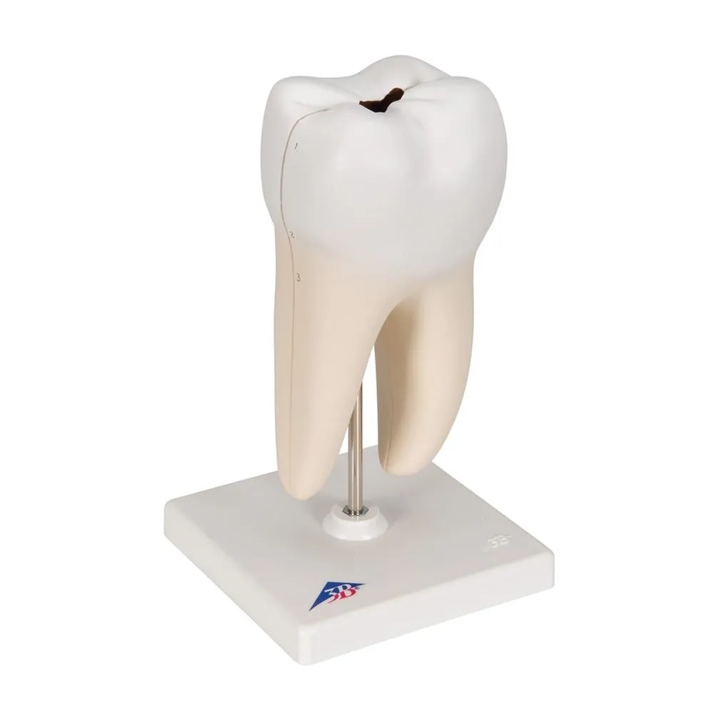 Lower Twin-Root Molar Showing Cavities, 2 part